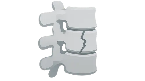 Spinal fracture management