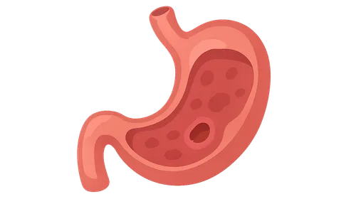 Gastritis and Peptic Ulcer Disease