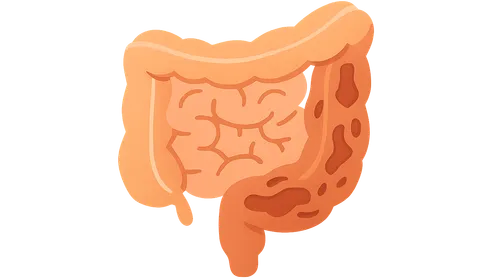 Inflammatory Bowel Disease