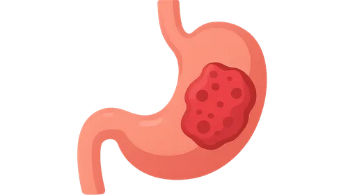 Gastric tumors