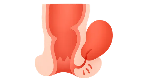 Anorectal Abscess and Fistula