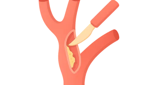Carotid endarterectomy indications and technique
