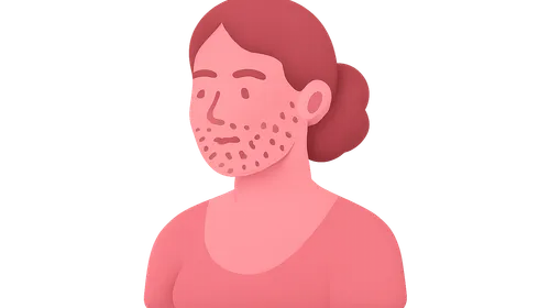 Hirsutism and Virilization