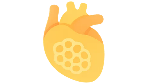 GSD type II (Pompe disease)