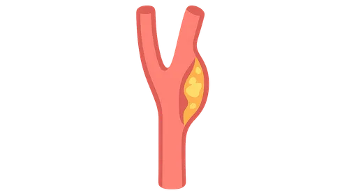Carotid Artery Disease