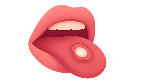 Oral Ulcers