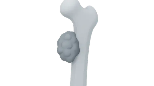 Bone and Soft Tissue Tumors