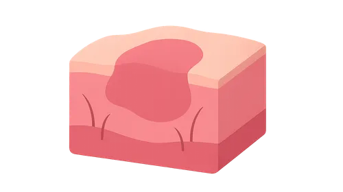 Scleroderma and Morphea