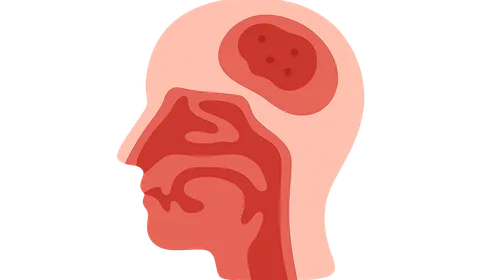 Intracranial Complications of Sinusitis