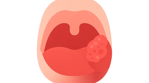 Oropharyngeal Carcinoma