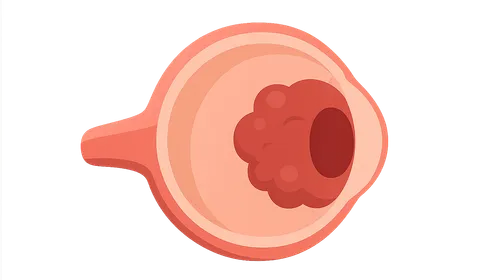 Retinoblastoma