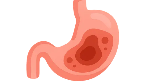 Intra-abdominal infections