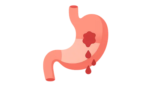 Gastrointestinal Bleeding