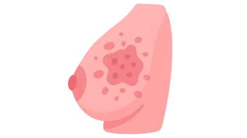 Inflammatory breast cancer
