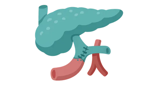 Pancreas Transplantation