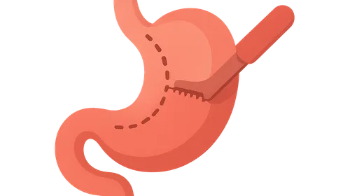 Gastric surgery procedures