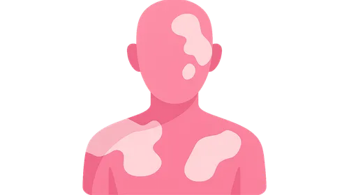 Vitiligo