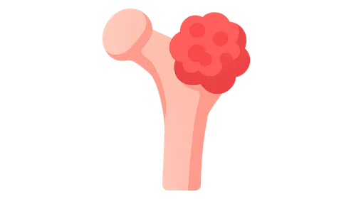 Malignant Primary Bone Tumors