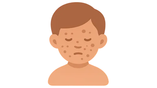 Pigmentary Disorders in Children