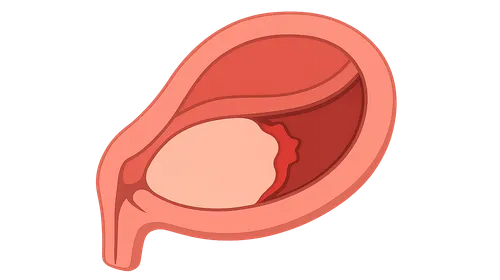 Placental abruption