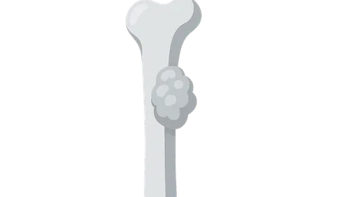Benign Bone Tumors