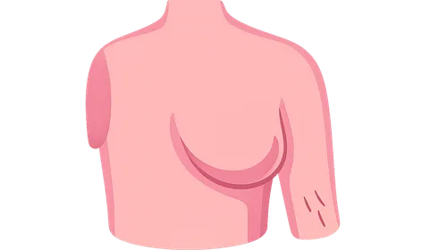 Mastectomy techniques and indications