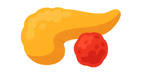 Pancreatic Adenocarcinoma