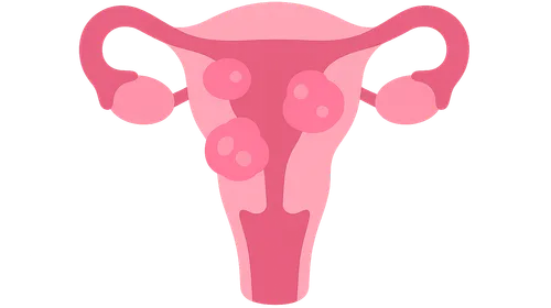 Uterine Fibroids