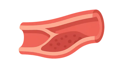 Atherosclerosis
