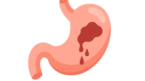 Gastrointestinal Bleeding