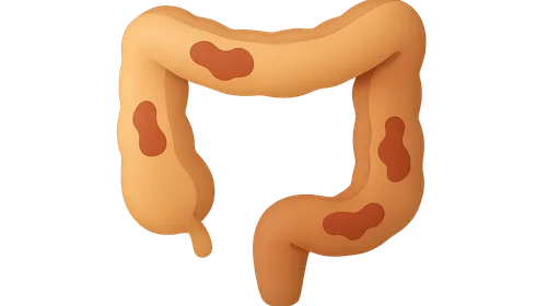 Inflammatory Bowel Disease