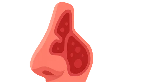 Diseases of the Nose and Paranasal Sinuses