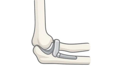 Elbow Arthroplasty