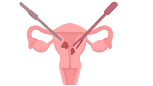 Endometriosis surgical management