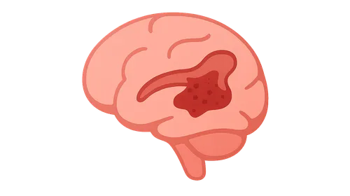 Intraventricular Hemorrhage