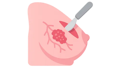 Management of Ductal Carcinoma In Situ