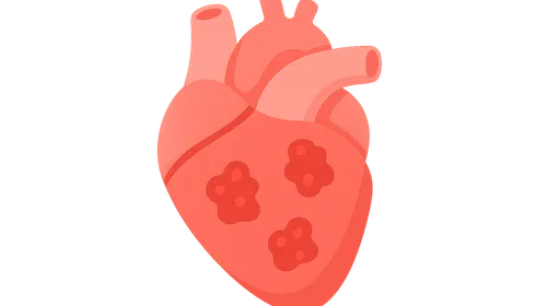 Infective endocarditis