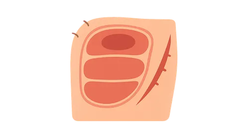 Compartment syndrome diagnosis and fasciotomy