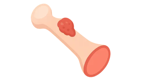 Amputation for Bone Tumors