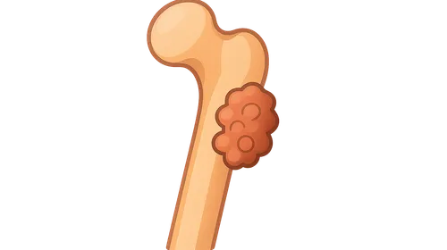 Metastatic Bone Disease