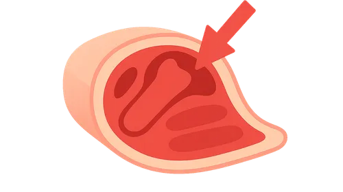 Compartment syndrome pathophysiology