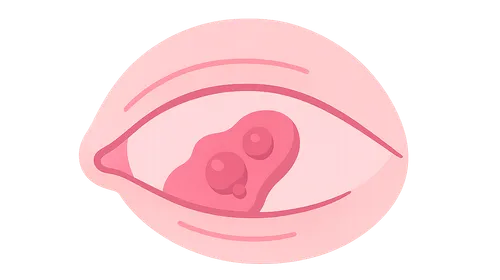 Degenerations of Conjunctiva