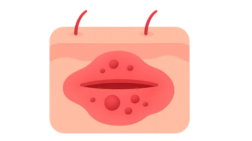 Surgical site infections