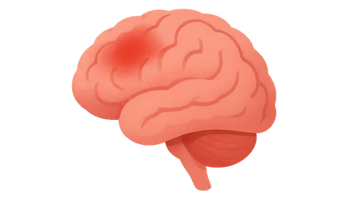 Neuroleptic Malignant Syndrome