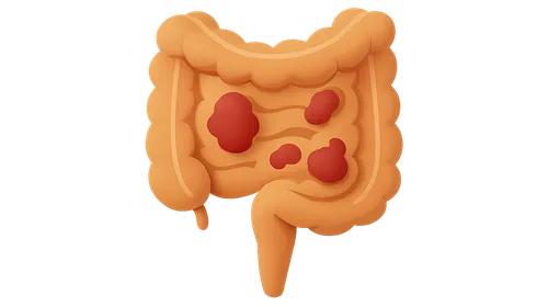 Inflammatory Bowel Disease