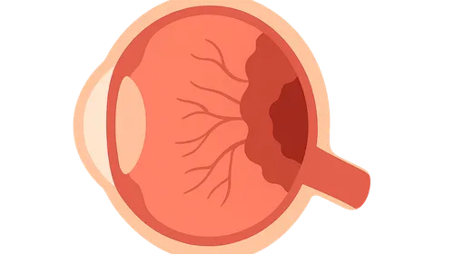 Diseases of the Retina