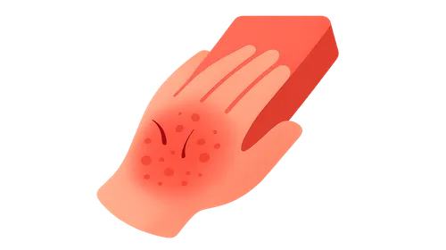 Irritant Contact Dermatitis in Workplace