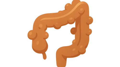 Diverticular Disease