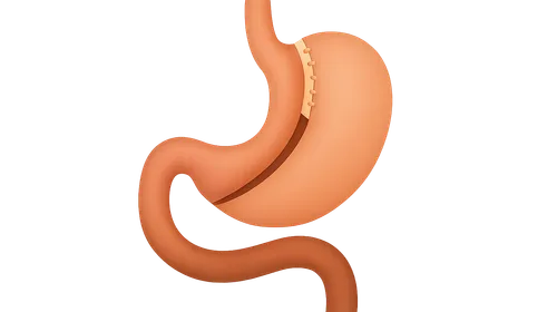 Malabsorptive Procedures