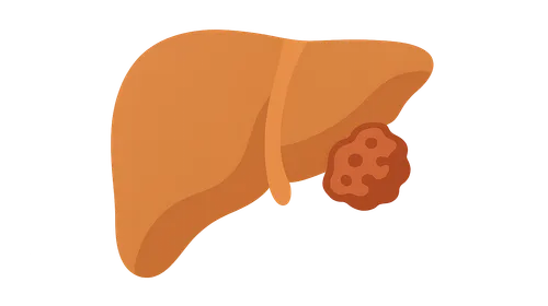 Hepatocellular Carcinoma